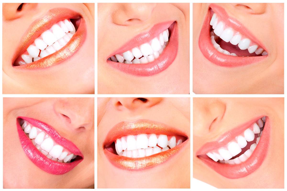 Отбеливание зубов: как сделать улыбку белоснежной?