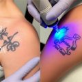 Лазерное удаление татуировок: правда, мифы и что стоит знать перед процедурой